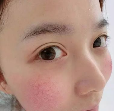 皮肤容易过敏的处理方法