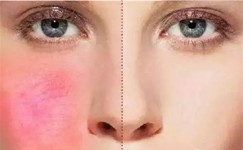 激素脸红血丝症状为什么那么难修复