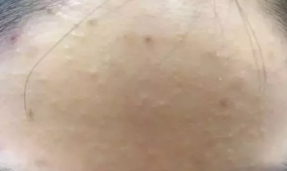 去除粉刺的注意事项有哪些？