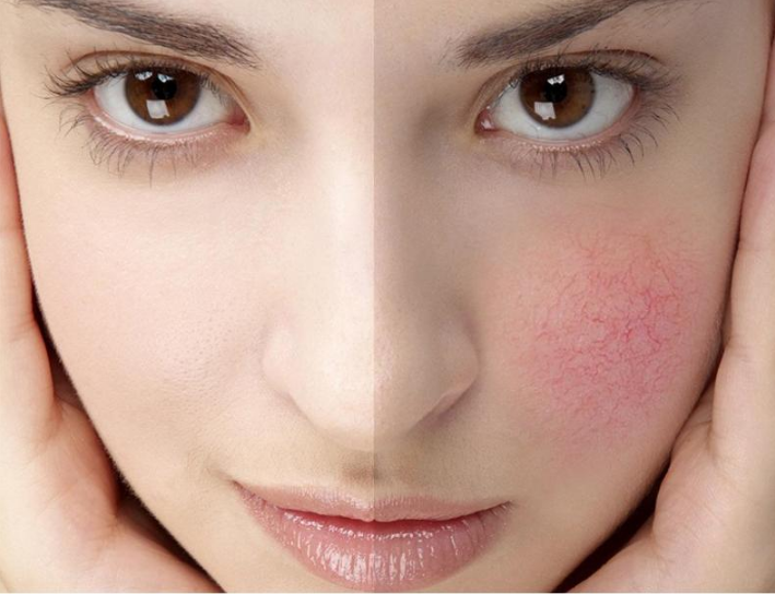 敏感肌换季如何护理？