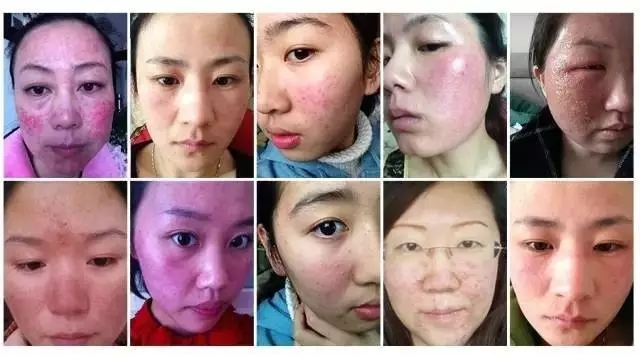 如何判断自己的皮肤是不是激素脸？