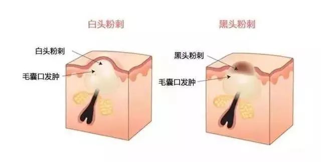 如何有效改善闭口粉刺？改善闭口粉刺的方法！