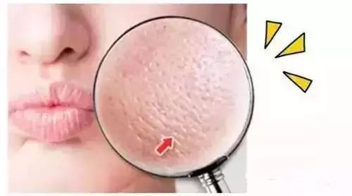 毛孔粗大怎么办？毛孔粗大的解决方法