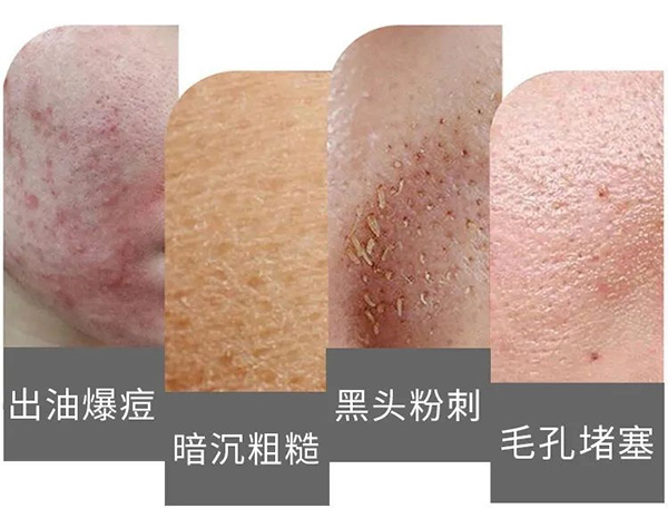 如何预防毛孔堵塞？预防毛孔堵塞的方法