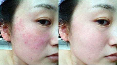 过敏肌肤怎么修复最快？