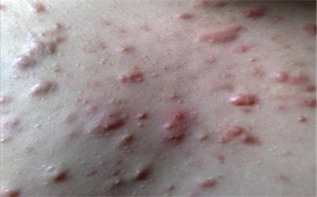 什么是痤疮，什么是粉刺？痤疮和粉刺有啥区别？