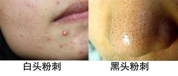 什么是痤疮，什么是粉刺？痤疮和粉刺有啥区别？