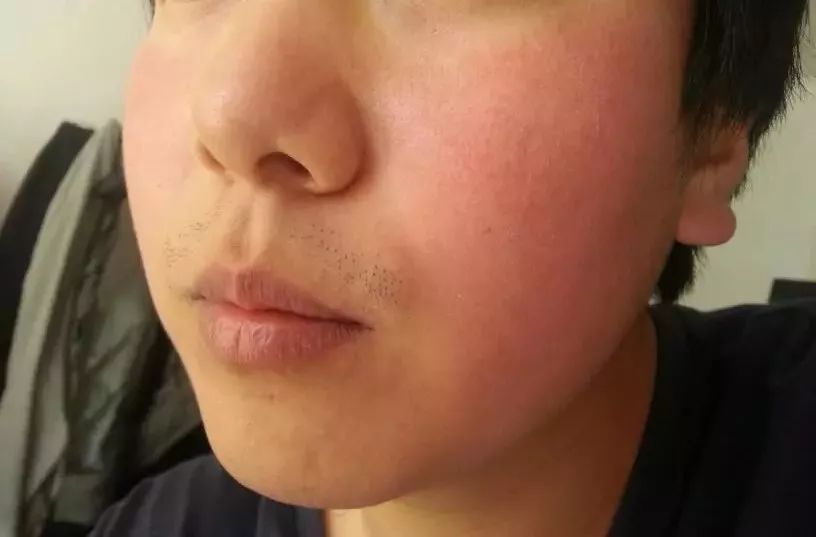 危险边缘型红血丝 红血丝的种类有哪些?