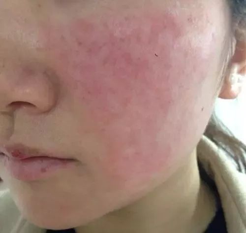 潮红型红血丝 红血丝的种类有哪些?