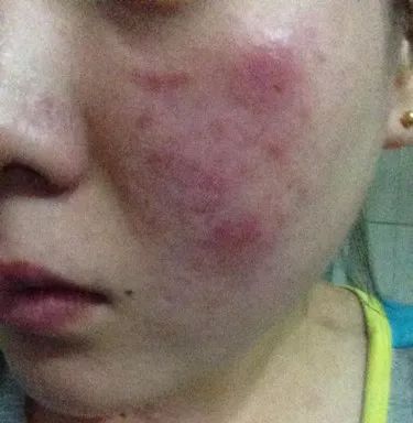 红血丝的种类有哪些？