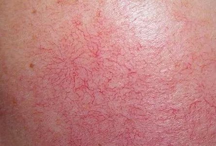 红血丝的种类有哪些？