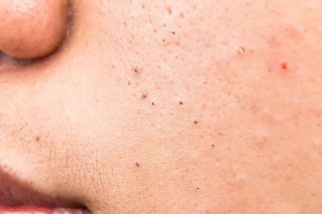 黑头是怎么形成的？如何预防黑头的产生？