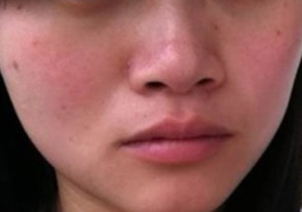 如何判断自己是不是敏感性皮肤？