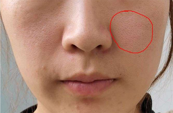毛孔粗大如何预防？毛孔粗大预防措施