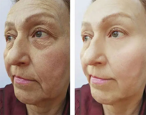脸部松弛下垂如何改善？面部松弛下垂改善方法！
