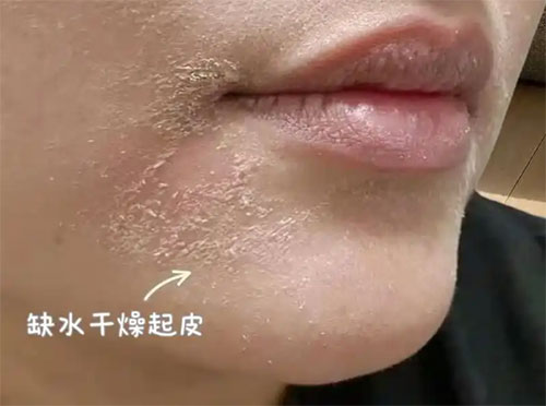 脸部脱皮干燥脱屑是怎么回事？
