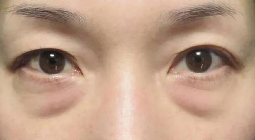 眼袋怎么治疗才能彻底消除？