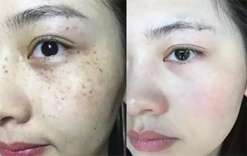 祛斑方法哪种效果最好？