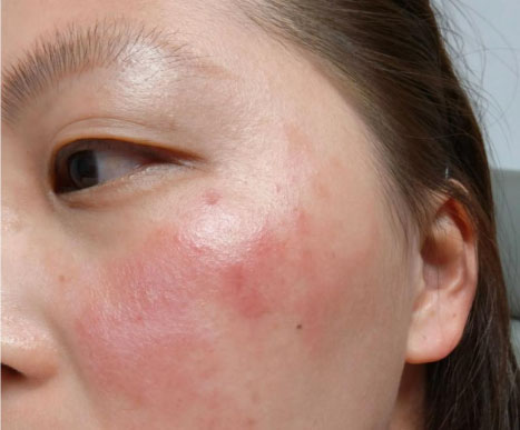 皮肤屏障受损的原因是什么？