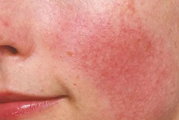 换季皮肤过敏怎么办？换季皮肤过敏的解决办法！