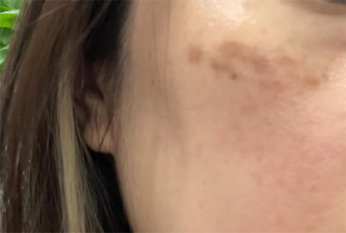 祛斑反黑色素沉着怎么消除？